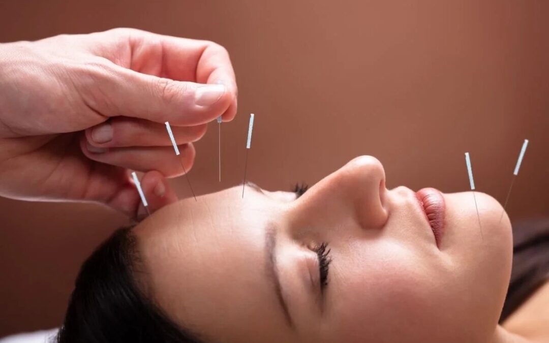 How Acupuncture in San Diego Can Improve Your Health and Wellness