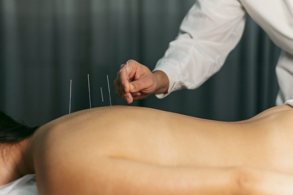 Therapist placing acupuncture needles on a client's back for overall health and wellness improvement.