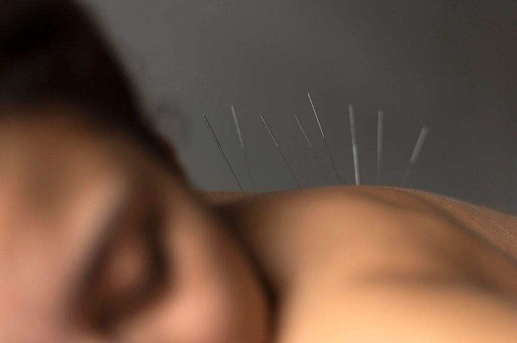  A client at Beauty Kliniek relaxes as multiple acupuncture needles are applied to the back for wellness and relief.