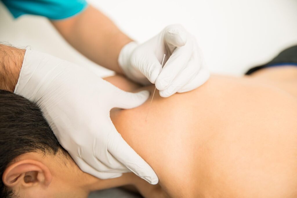  A Beauty Kliniek specialist wearing gloves carefully inserts a thin acupuncture needle into a client's upper back.
