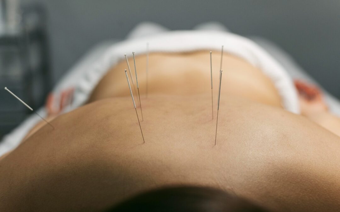 4 Specialized Forms of Acupuncture for Specific Wellness Goals