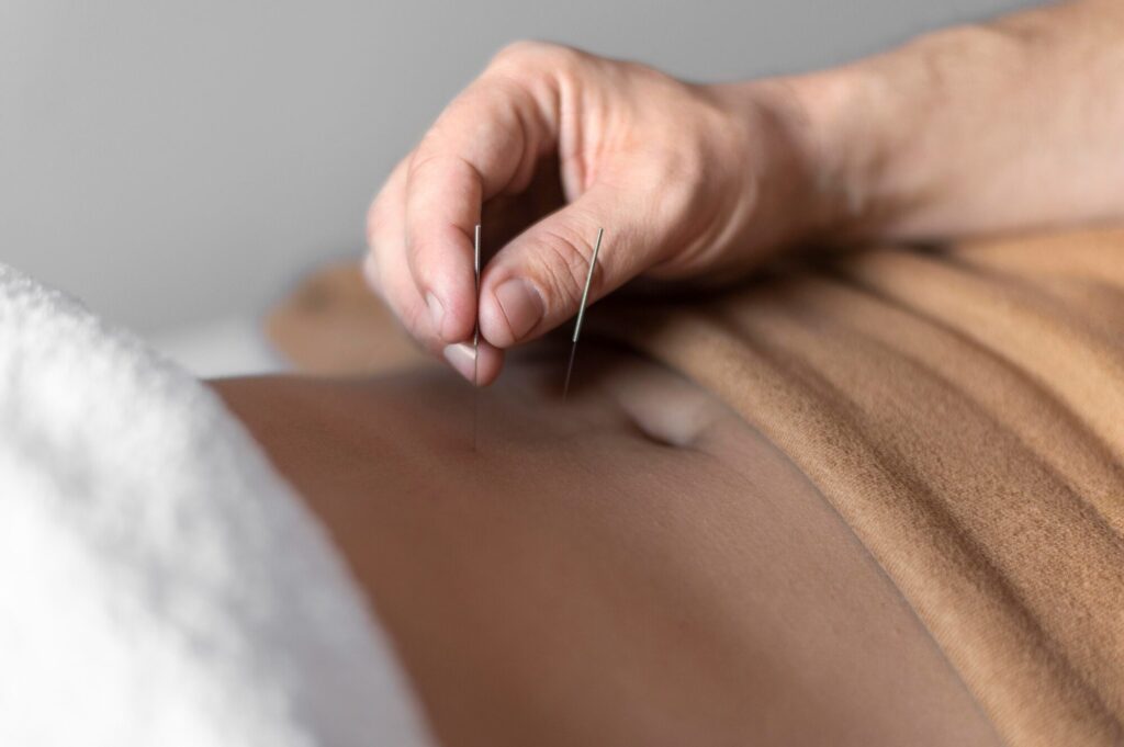 Specialized Beauty Kliniek acupuncture session focusing on abdominal points to treat digestive and wellness concerns.